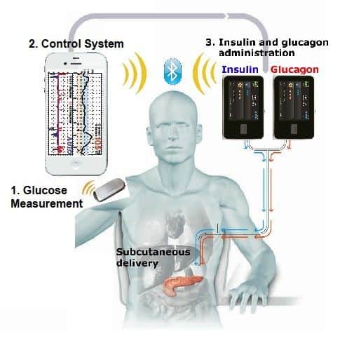 Artificial Pancreas diabetes