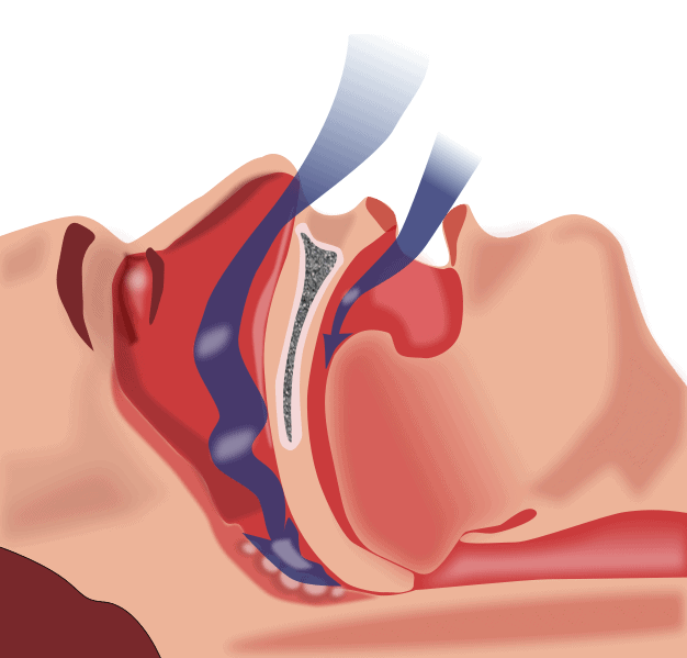 apnea