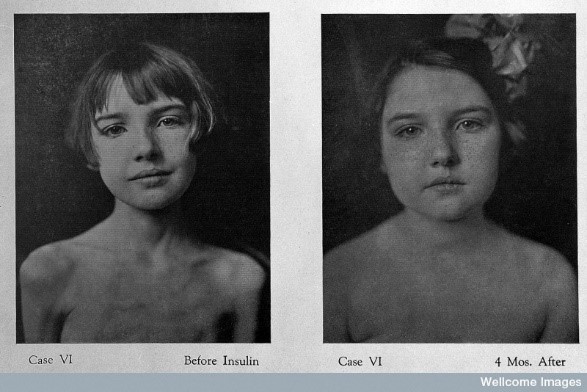 before-and-after-insulin