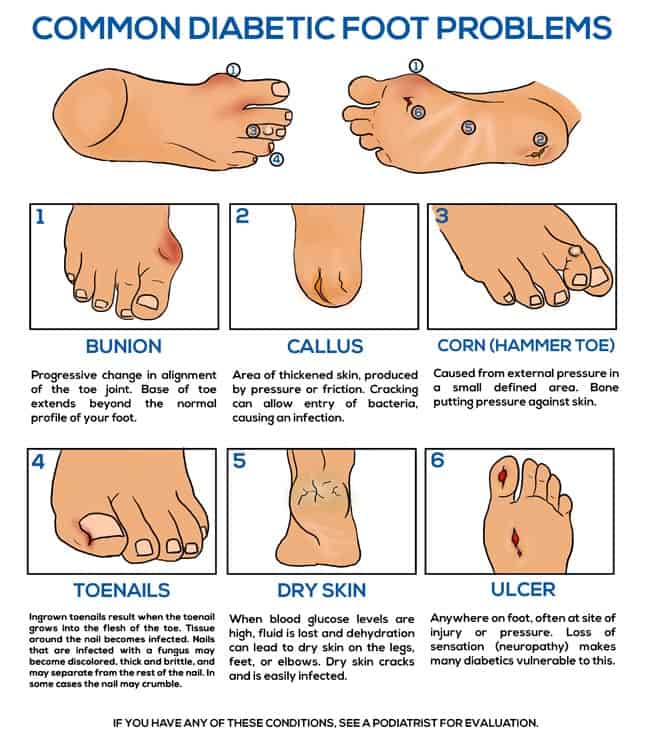 common diabetic foot problems