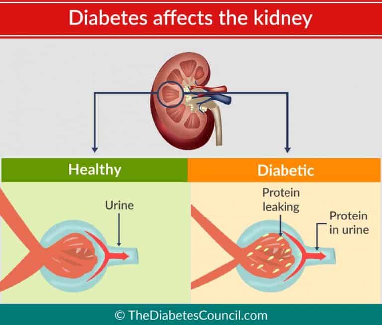 Diabetes And Renal Failure Everything You Need To Know