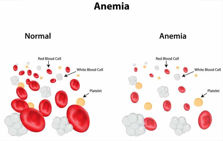 Gestational Diabetes Caused By Poor Diet And Anemia