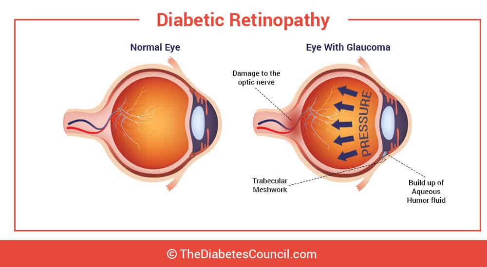 why does diabetes affect the eyes